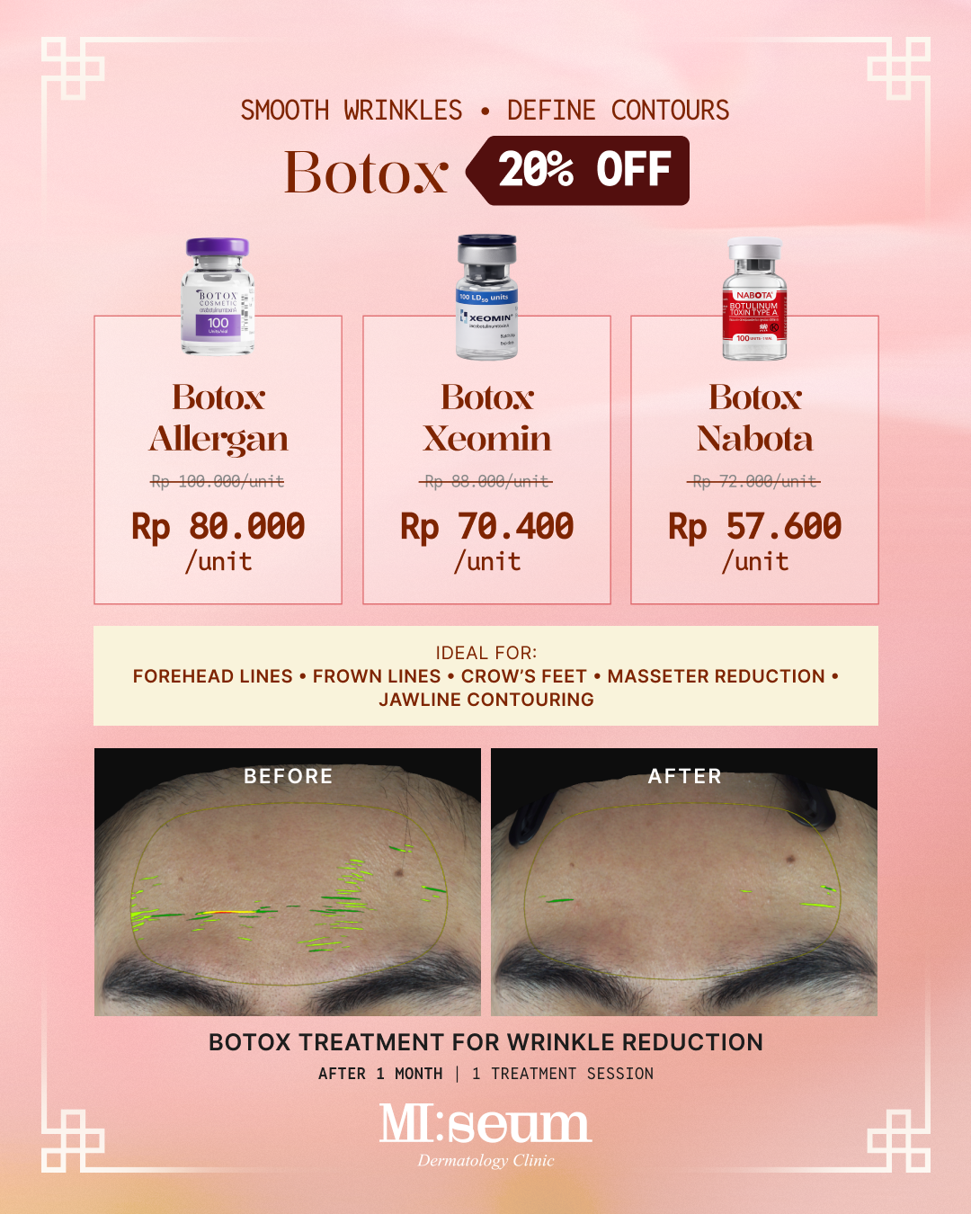 Botox Treatments 20% OFF