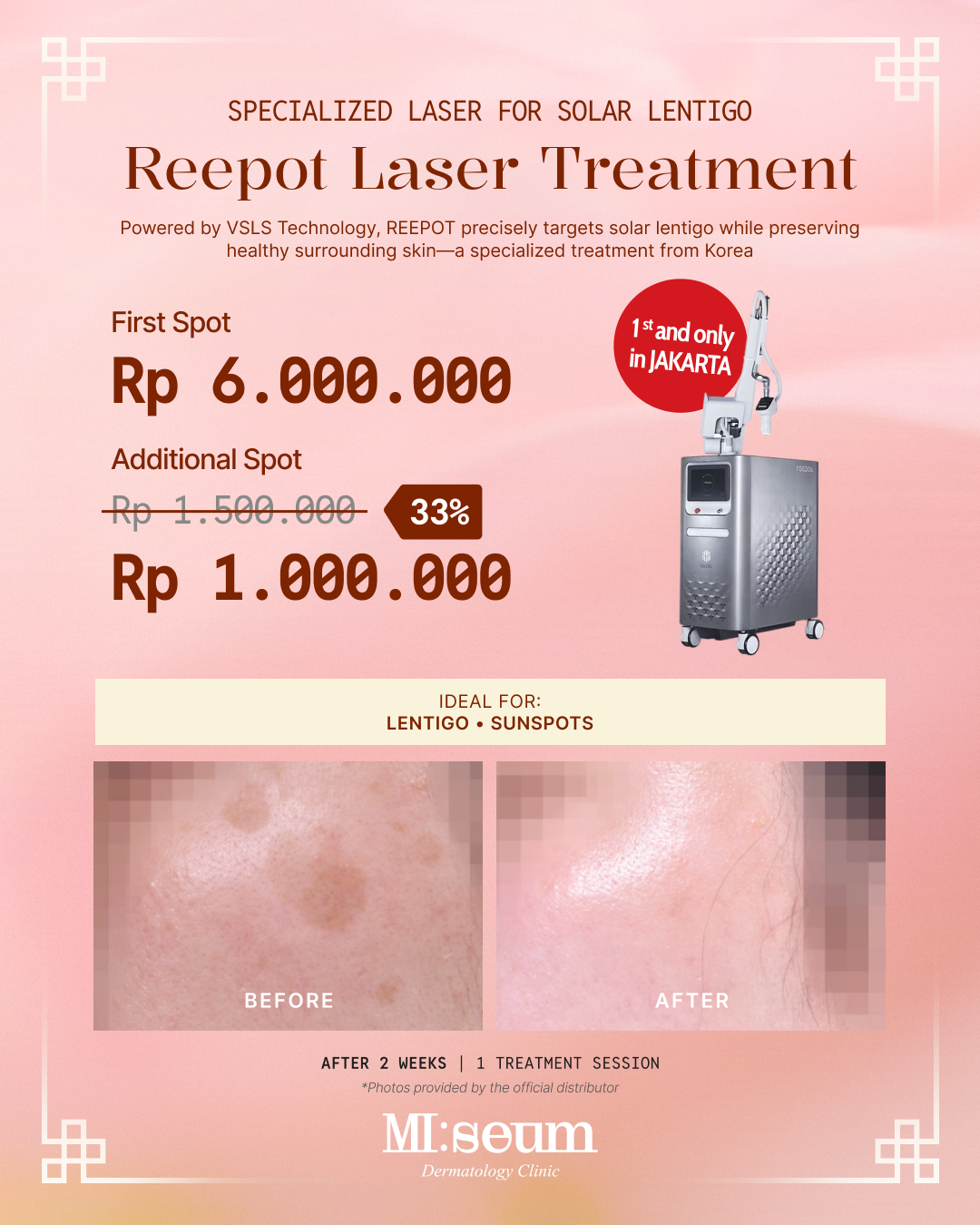 REEPOT Laser Treatment