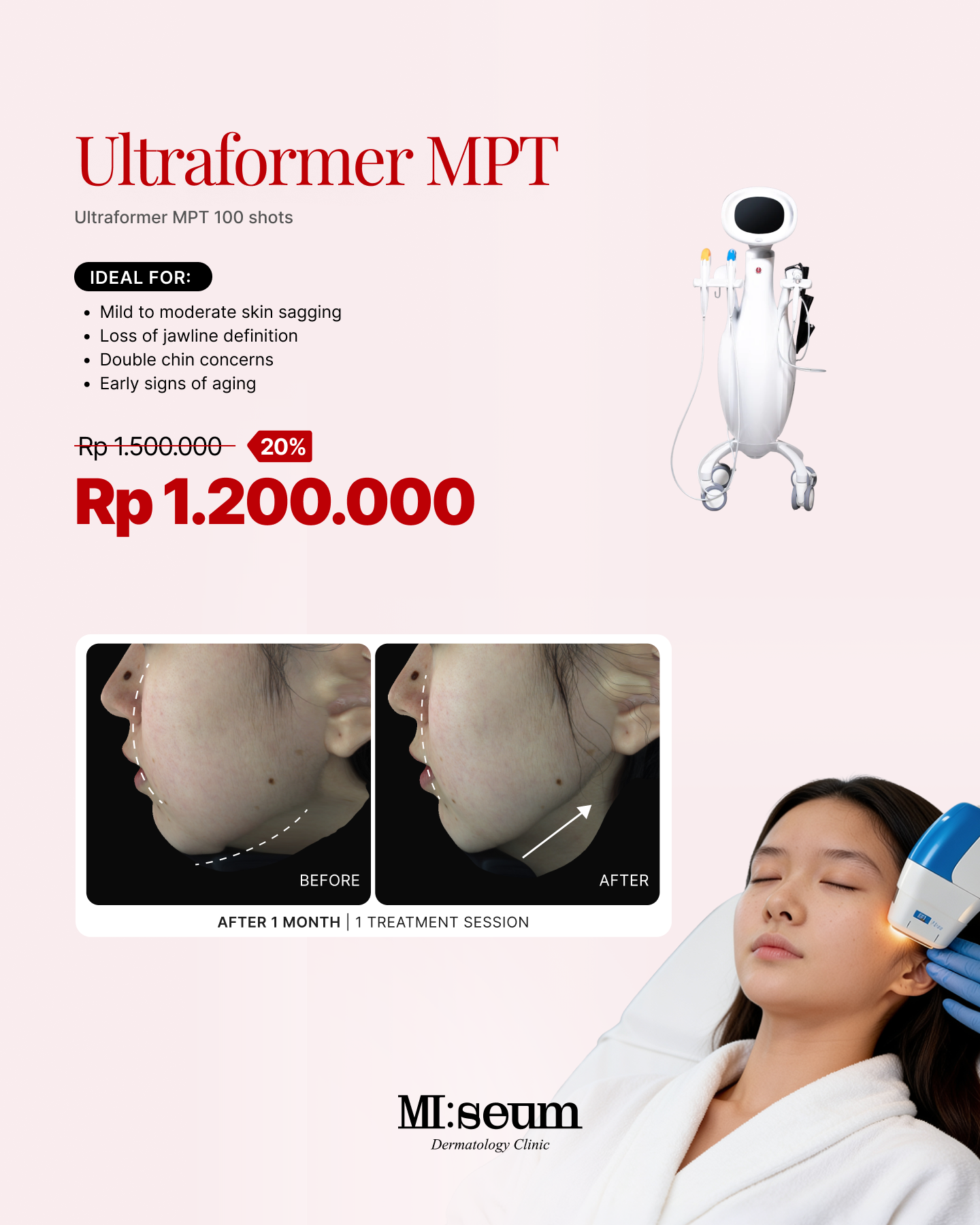 Ultraformer MPT