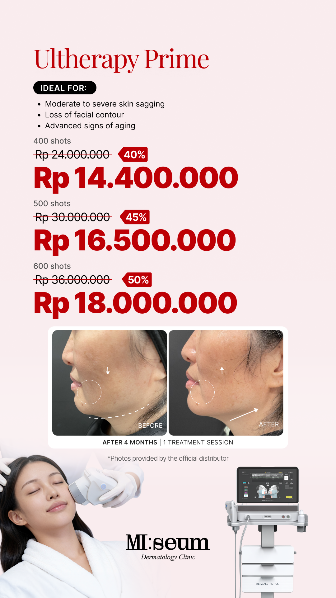 Ultherapy Prime