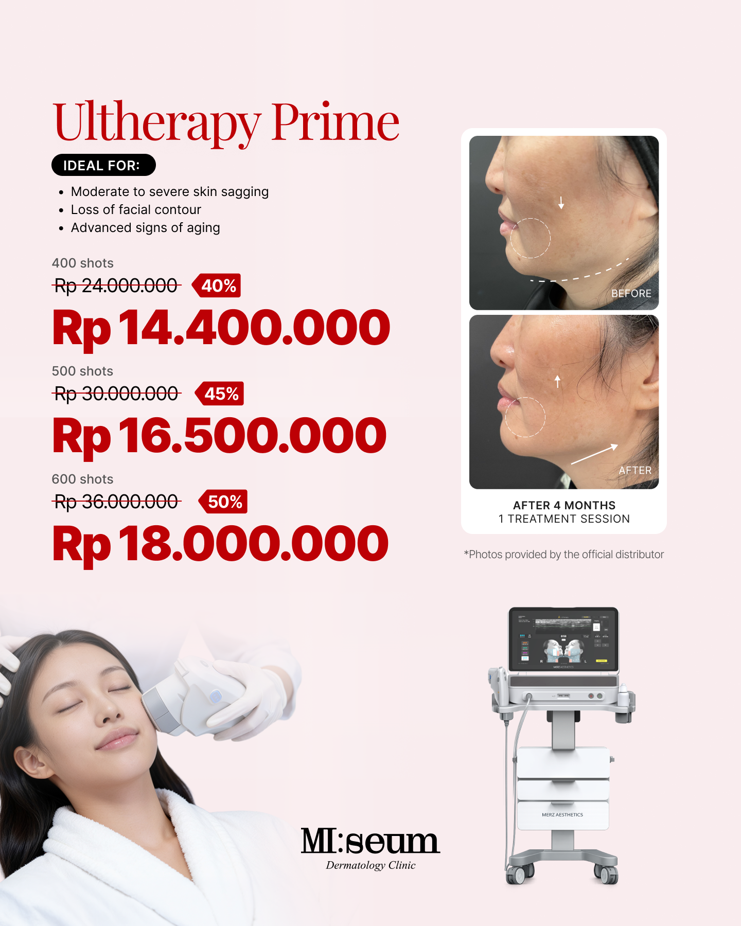 Ultherapy Prime