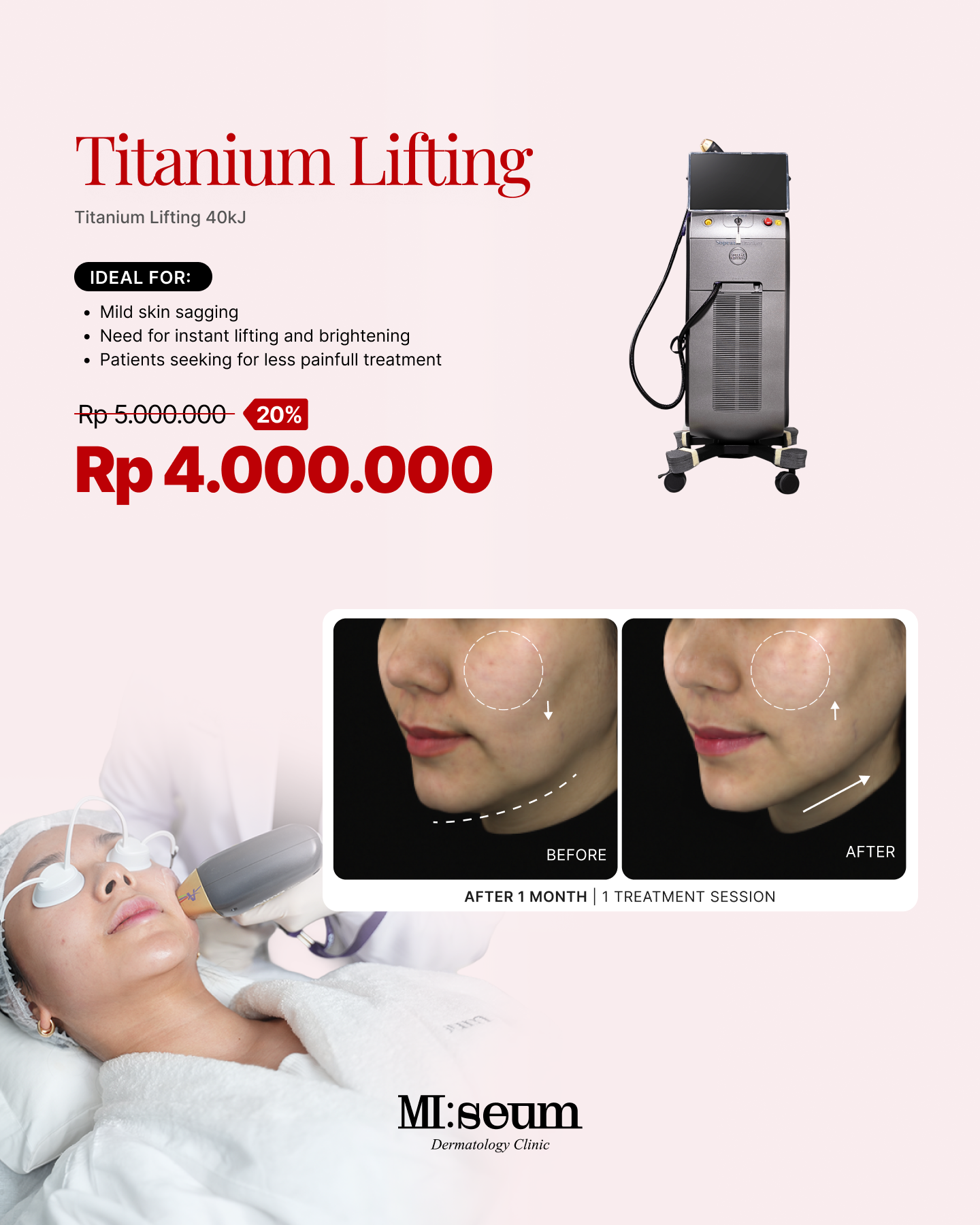 Titanium Lifting