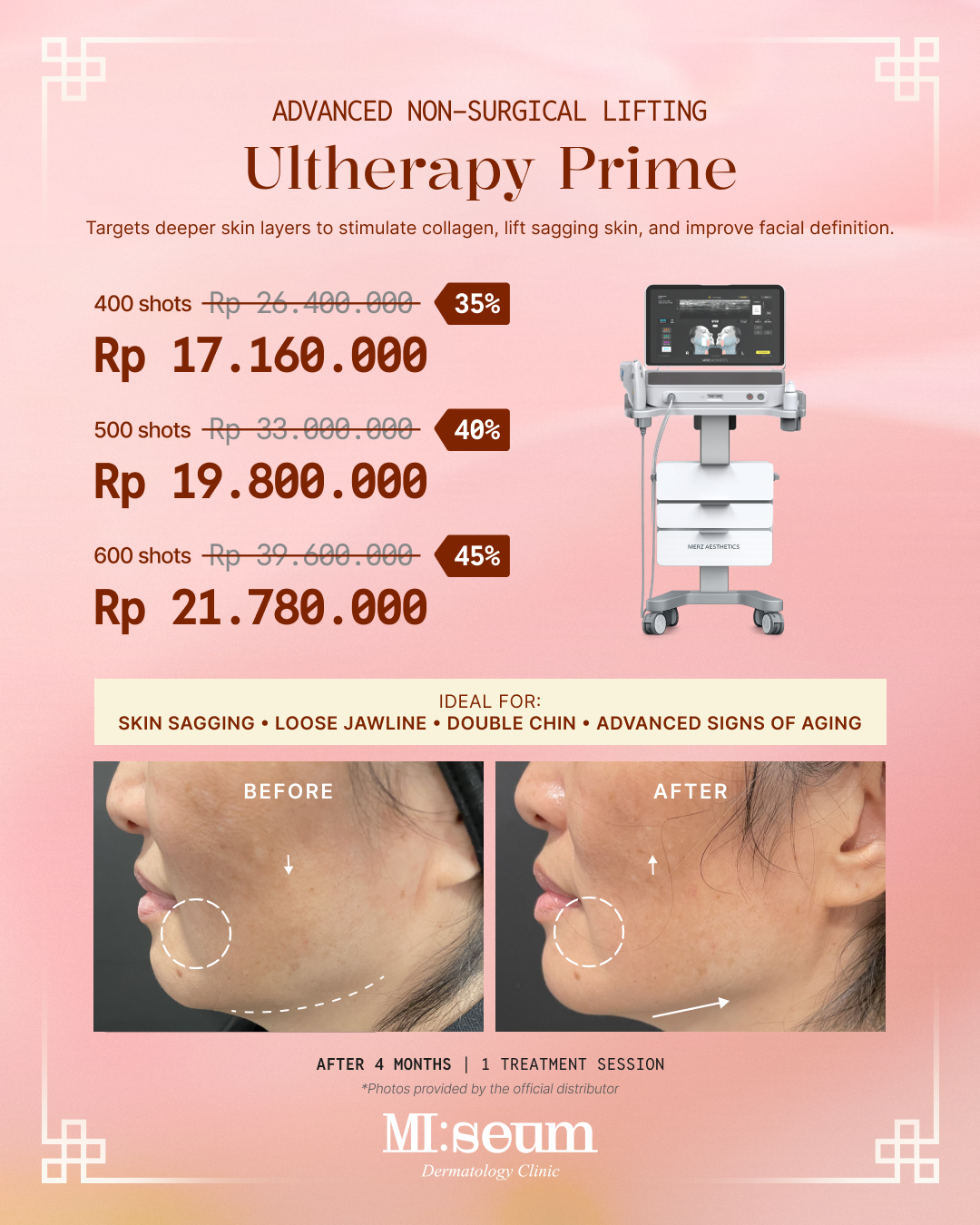 Ultherapy Prime