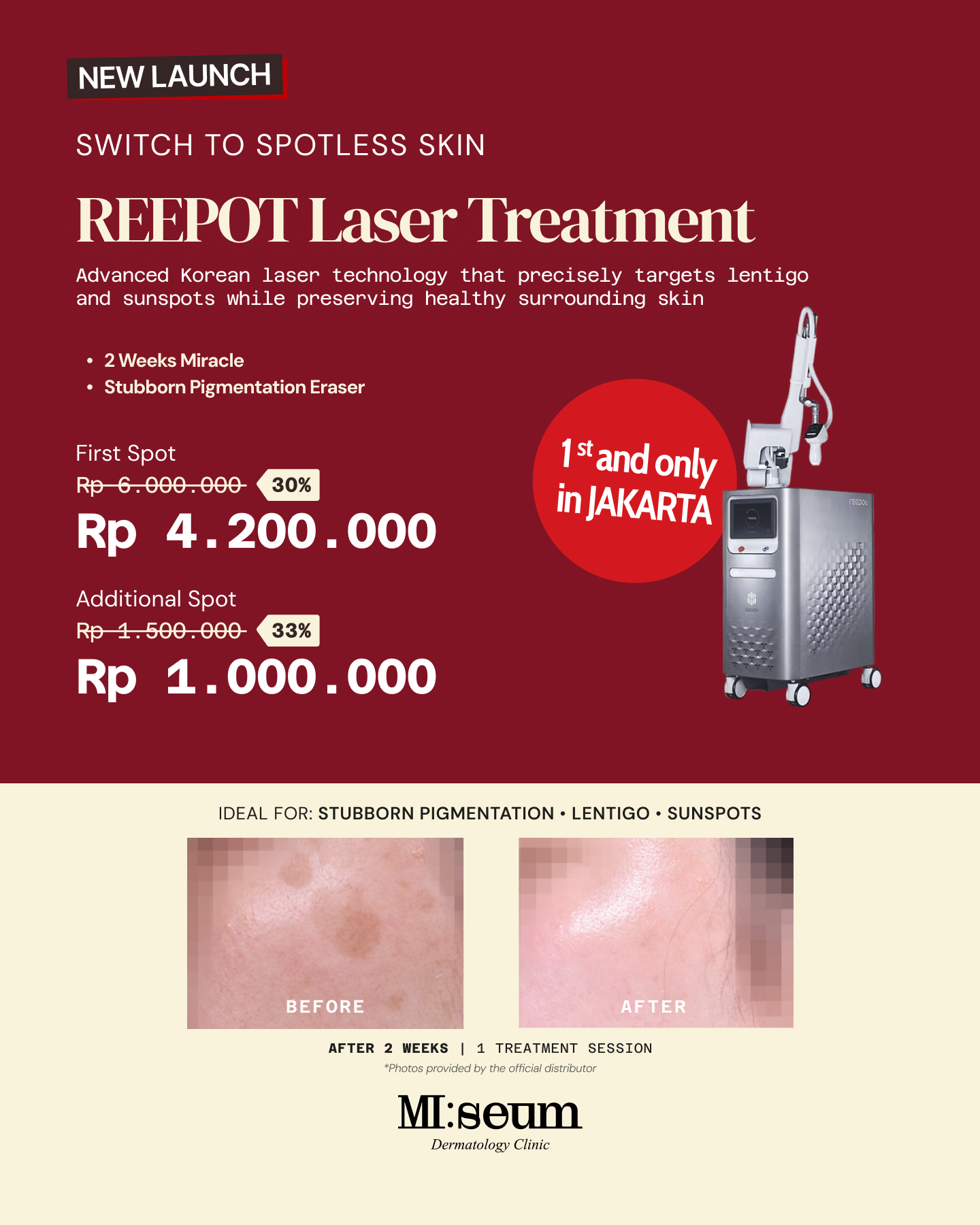 [NEW LAUNCH] REEPOT Laser Treatment