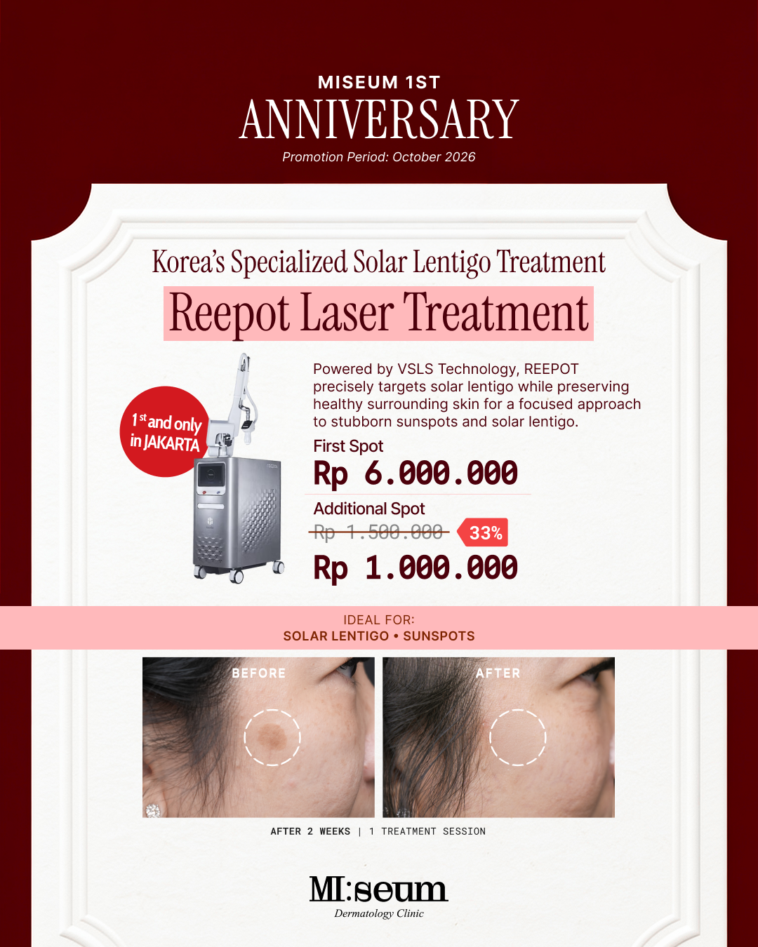REEPOT Laser Treatment
