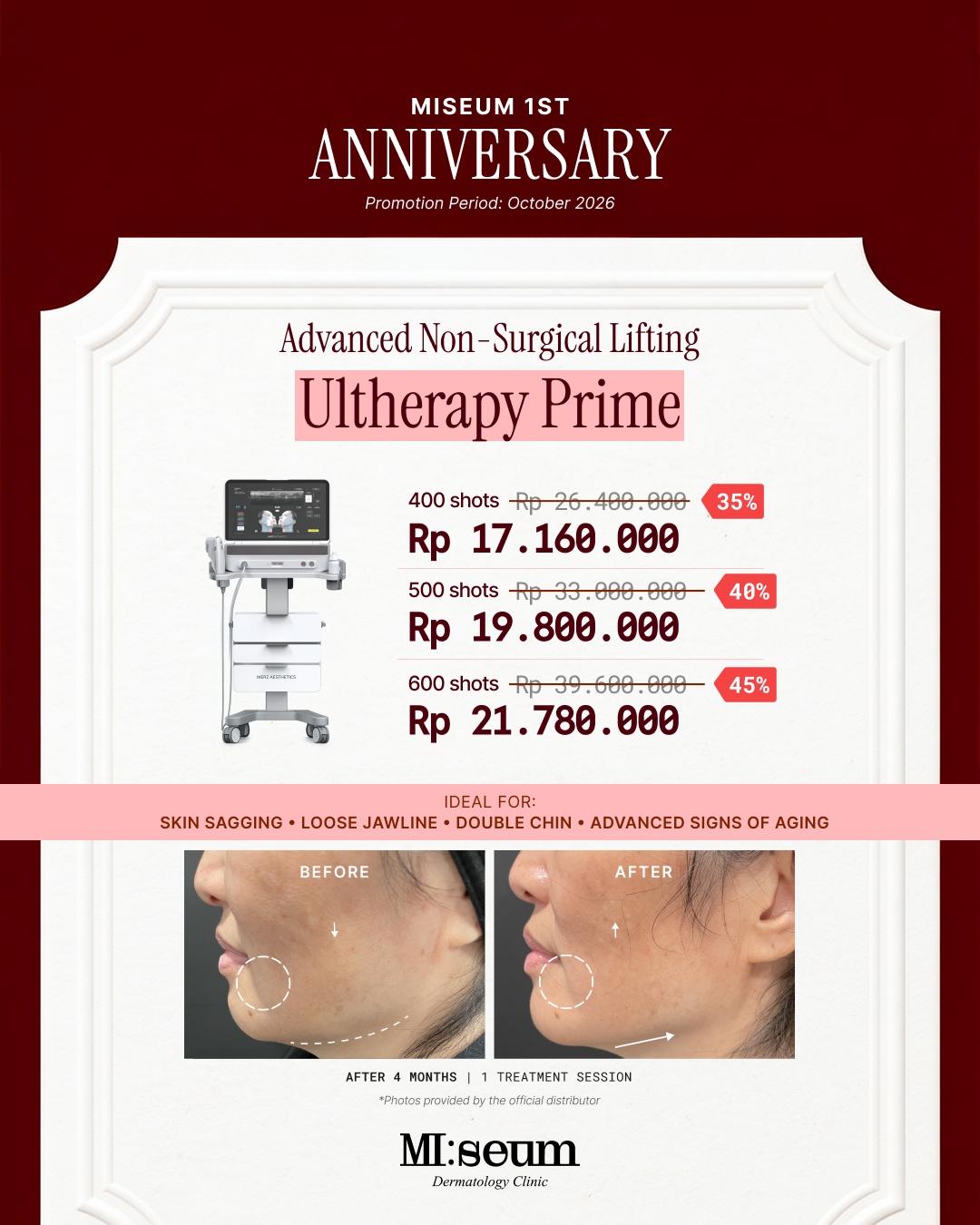 Ultherapy Prime
